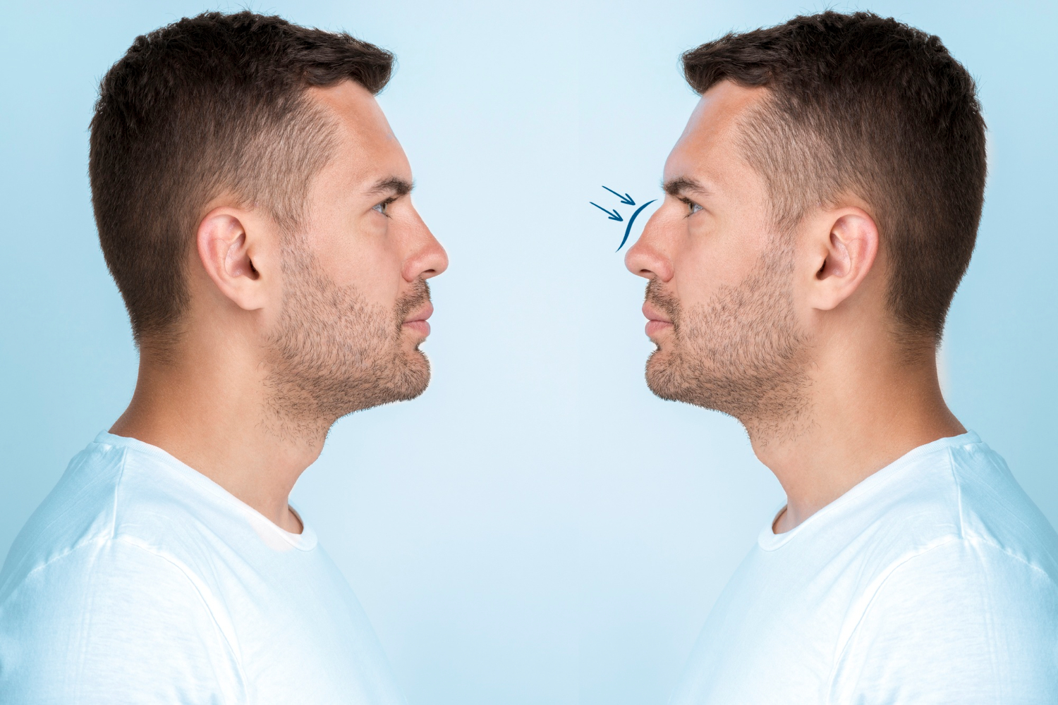 Endoscopic Septum Correction