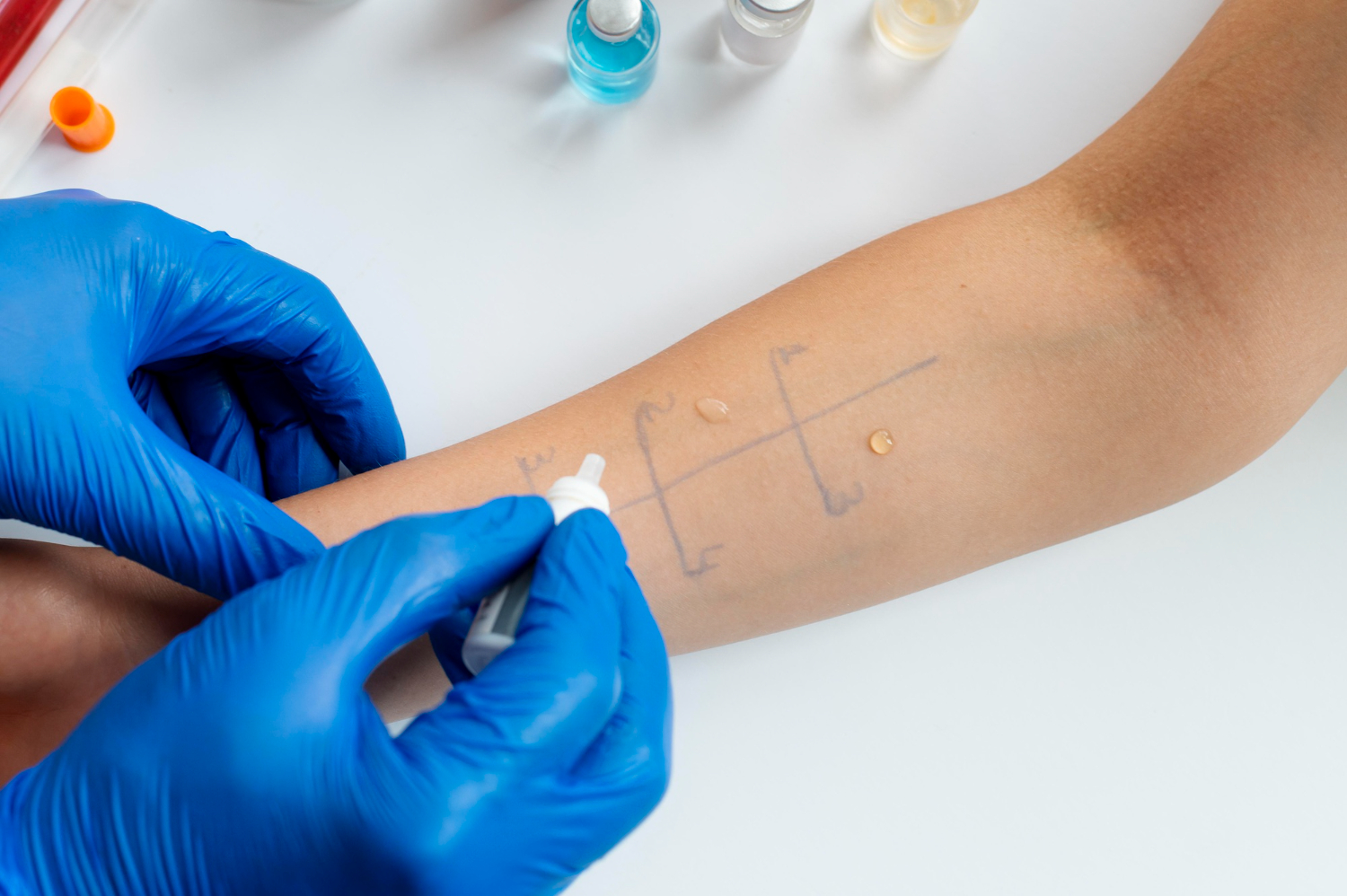 Skin Prick Allergy Test