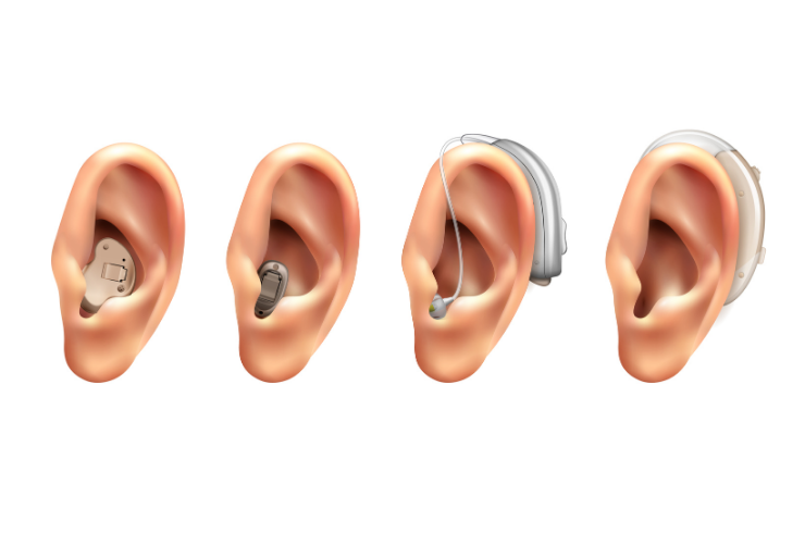 Cochlear Implant